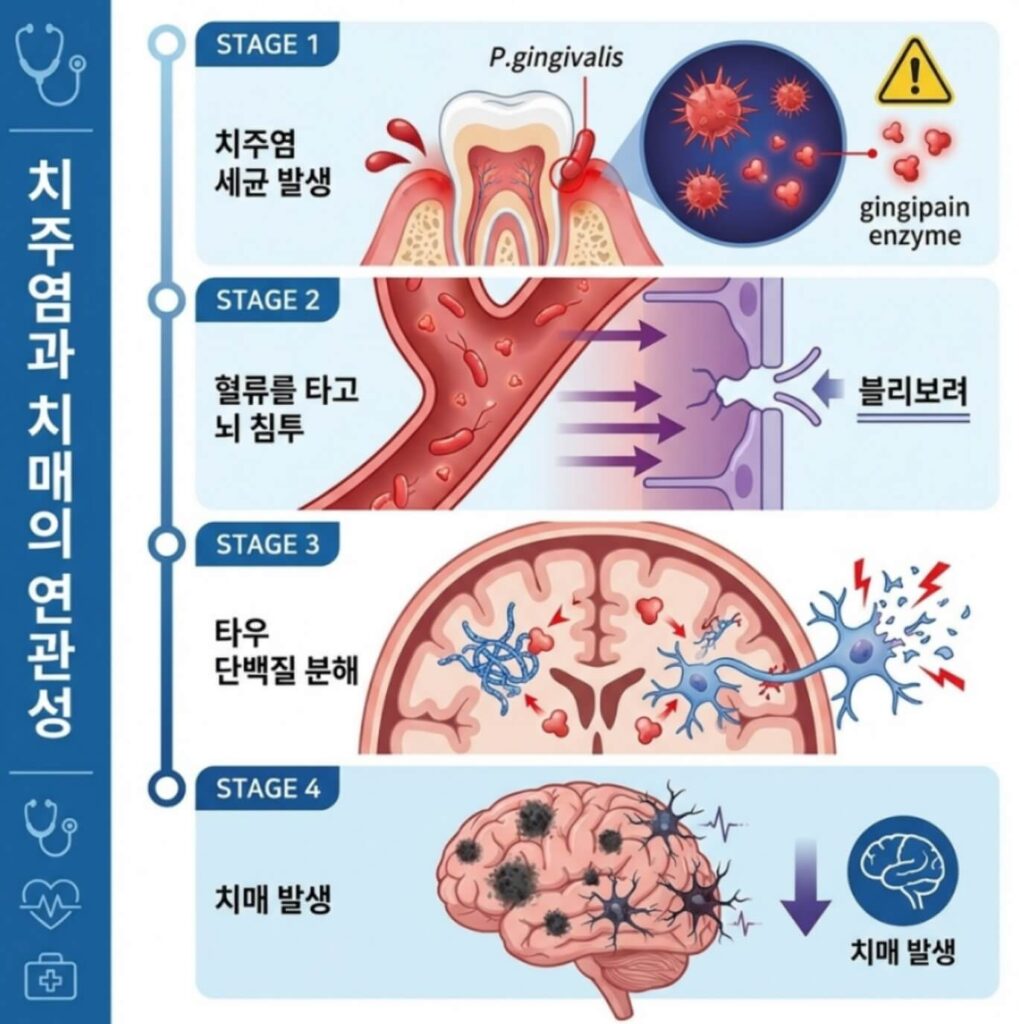  치주염 치매 당뇨 영향
