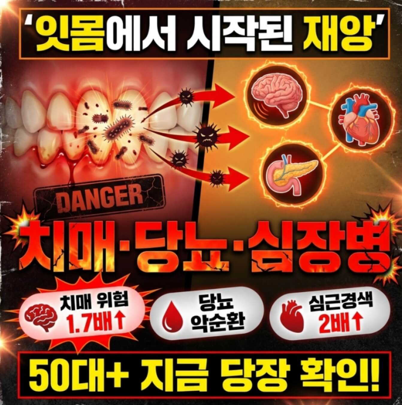  치주염 치매 당뇨 영향