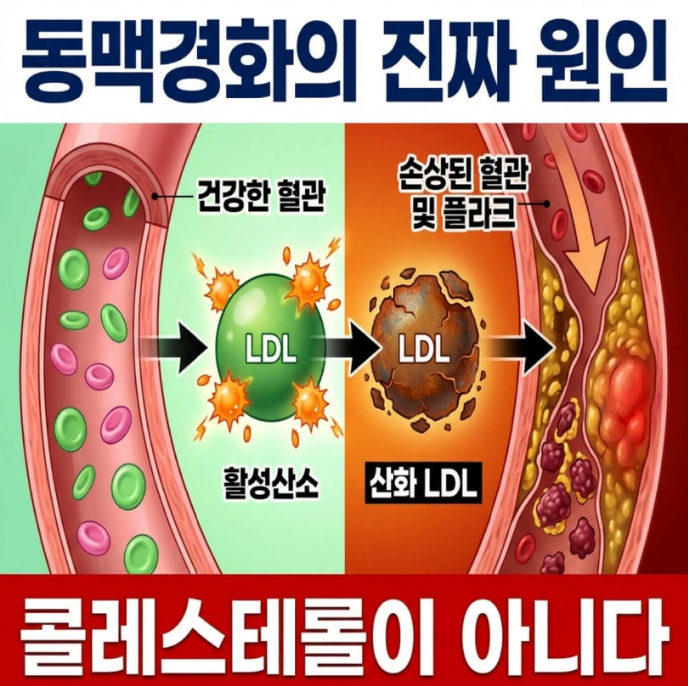 동맥경화 증상