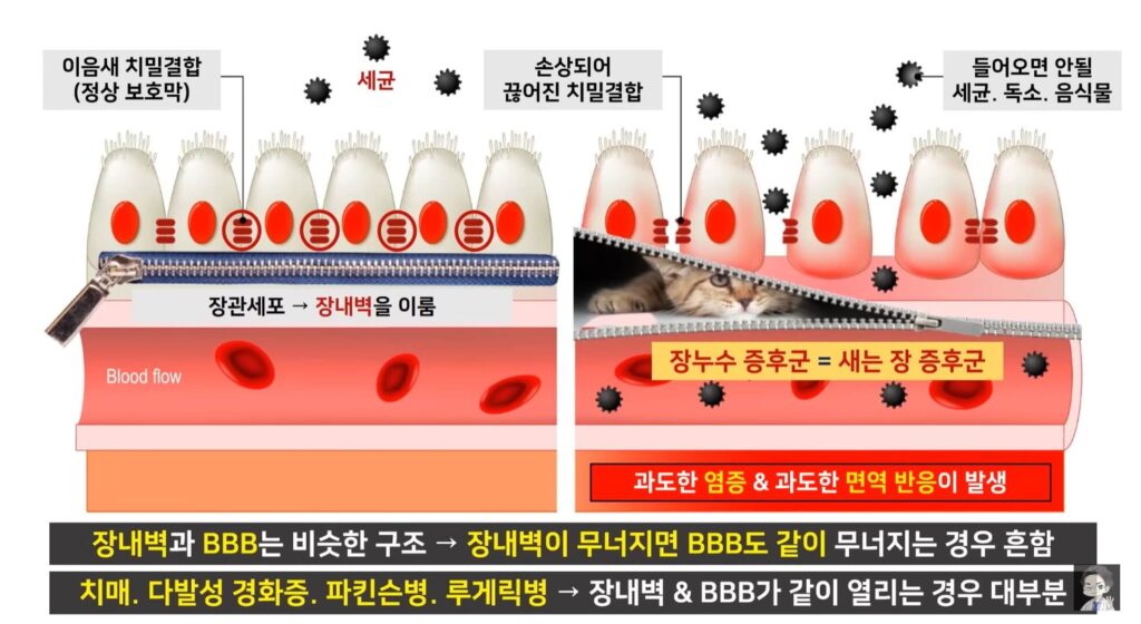 장 누수 증후군 원인