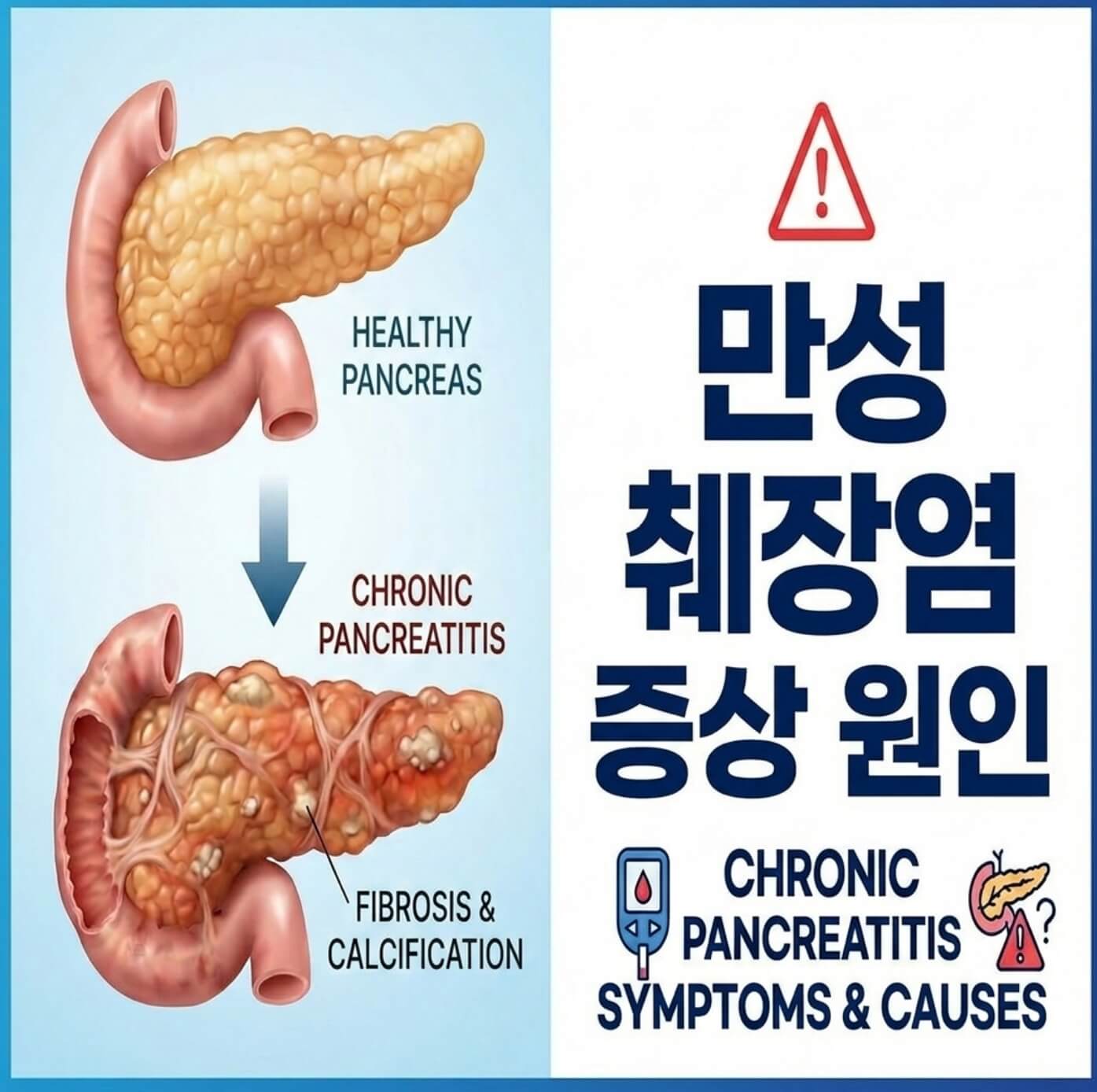 만성 췌장염 증상 원인