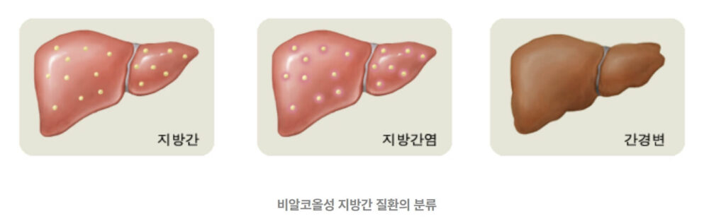 지방간 간수치 증상 원인 치료 영양제 회복 방법